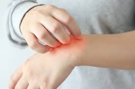 Piel Atópica en Niños: Mi Guía Natural (¡Adiós Brotes!)